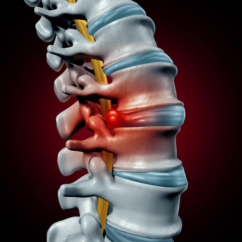 A Herniated Disc or a Bulging Disc: Is There a Difference, and How Can