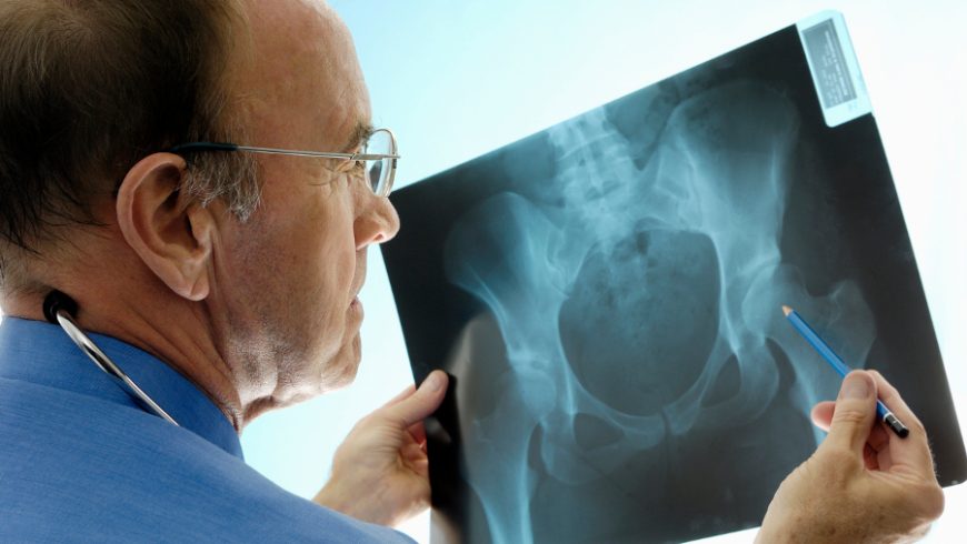 Osteoporosis: Winning the Battle Against Bone Loss