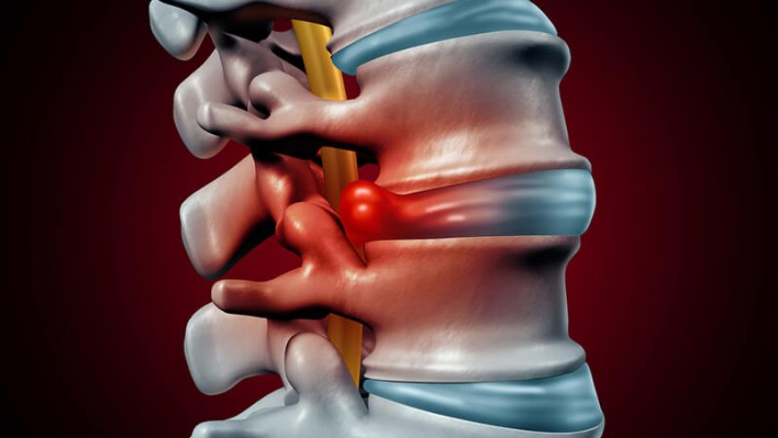 A Herniated Disc or a Bulging Disc: Is There a Difference, and How Can I Tell?