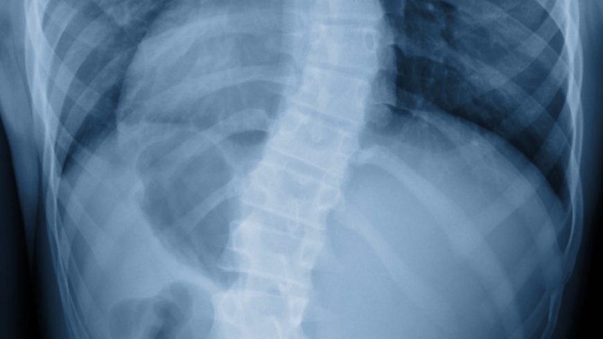 Understanding a Scoliosis Diagnosis