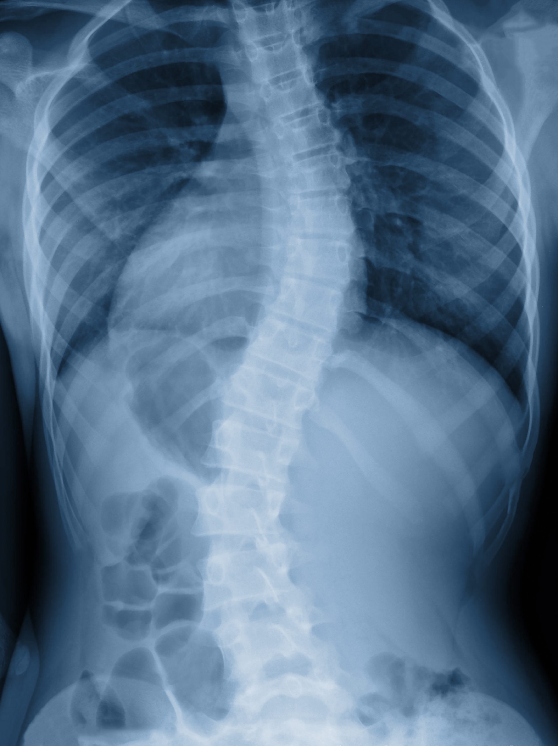 Understanding a Scoliosis Diagnosis