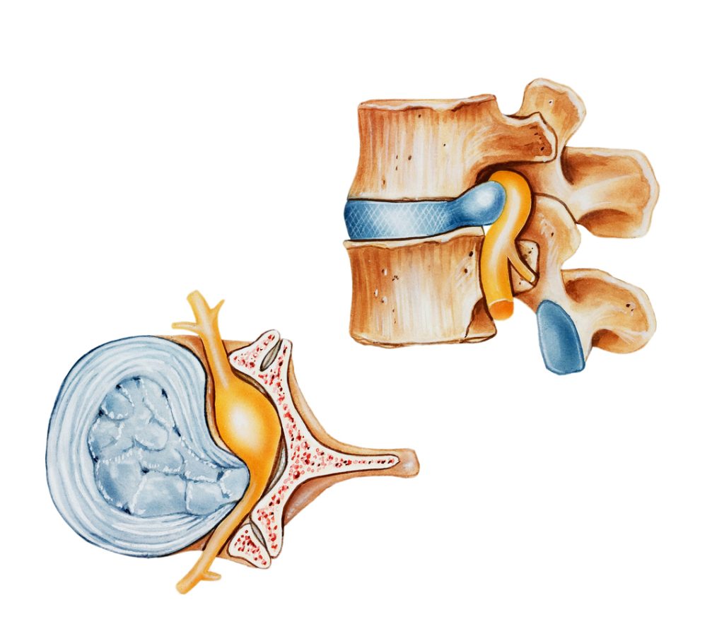 "A herniated (slipped or ruptured) disc, side (top) and top (left) views. Shown is a ruptured.disc (with the nucleus coming out of the annulus) pushing into the spinal canal, leading to pressure on the spinal cord and root nerve."