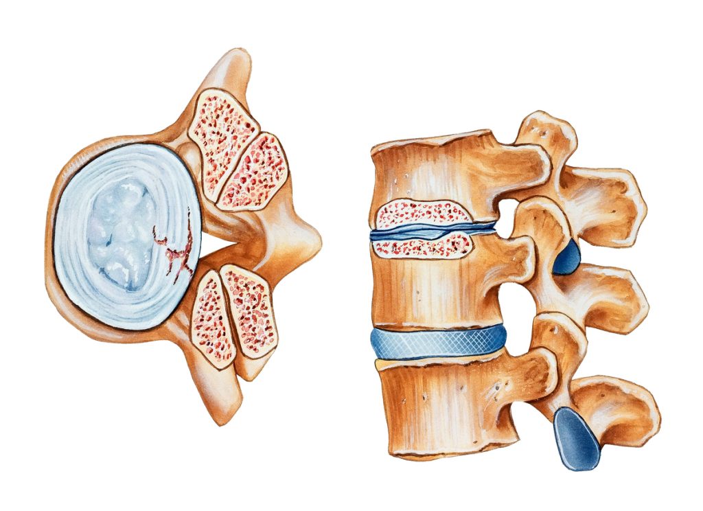 "Spinal stenosis. The top view (left) shows the superior articular process of the inferior vertebra, the inferior articular process of the superior vertebra, and the narrowed spinal canal. A side view (right) shows a damaged intervertebral disc with a loss of disc height and narrowed lumbar vertebrae (top) and a normal disc.(bottom)."