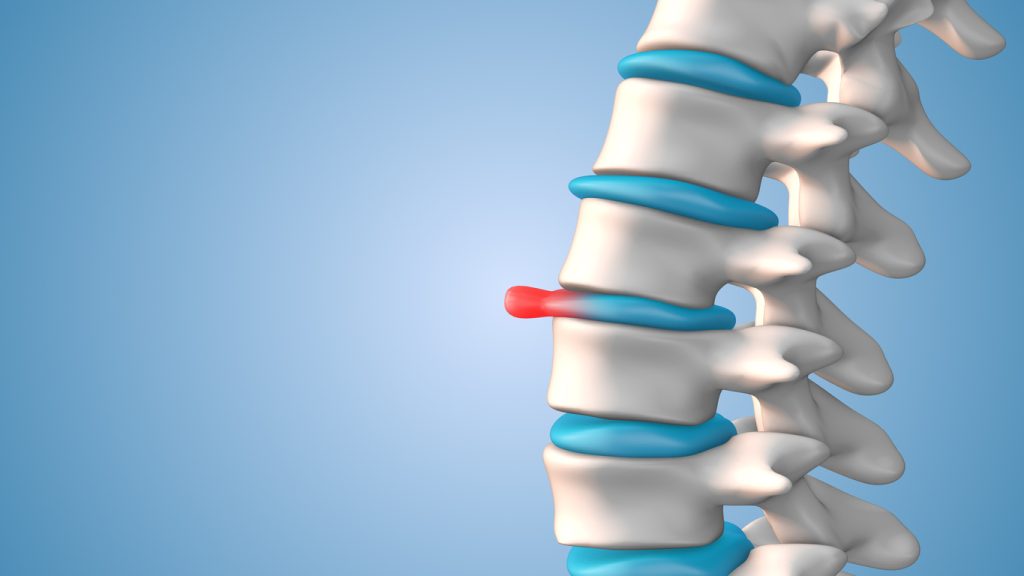 Spinal disc herniation, commonly known as a herniated disc or slipped disc, can cause varying degrees of pain and discomfort. It occurs when the soft inner portion of a spinal disc pushes through a crack in the tougher outer layer, potentially irritating or compressing nearby nerves. The location and severity of the herniation will influence the type and intensity of pain experienced.